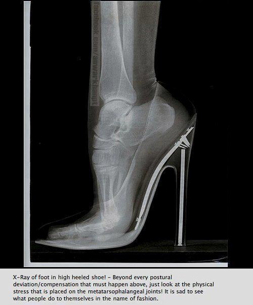 Back pain fashion from wearing heels